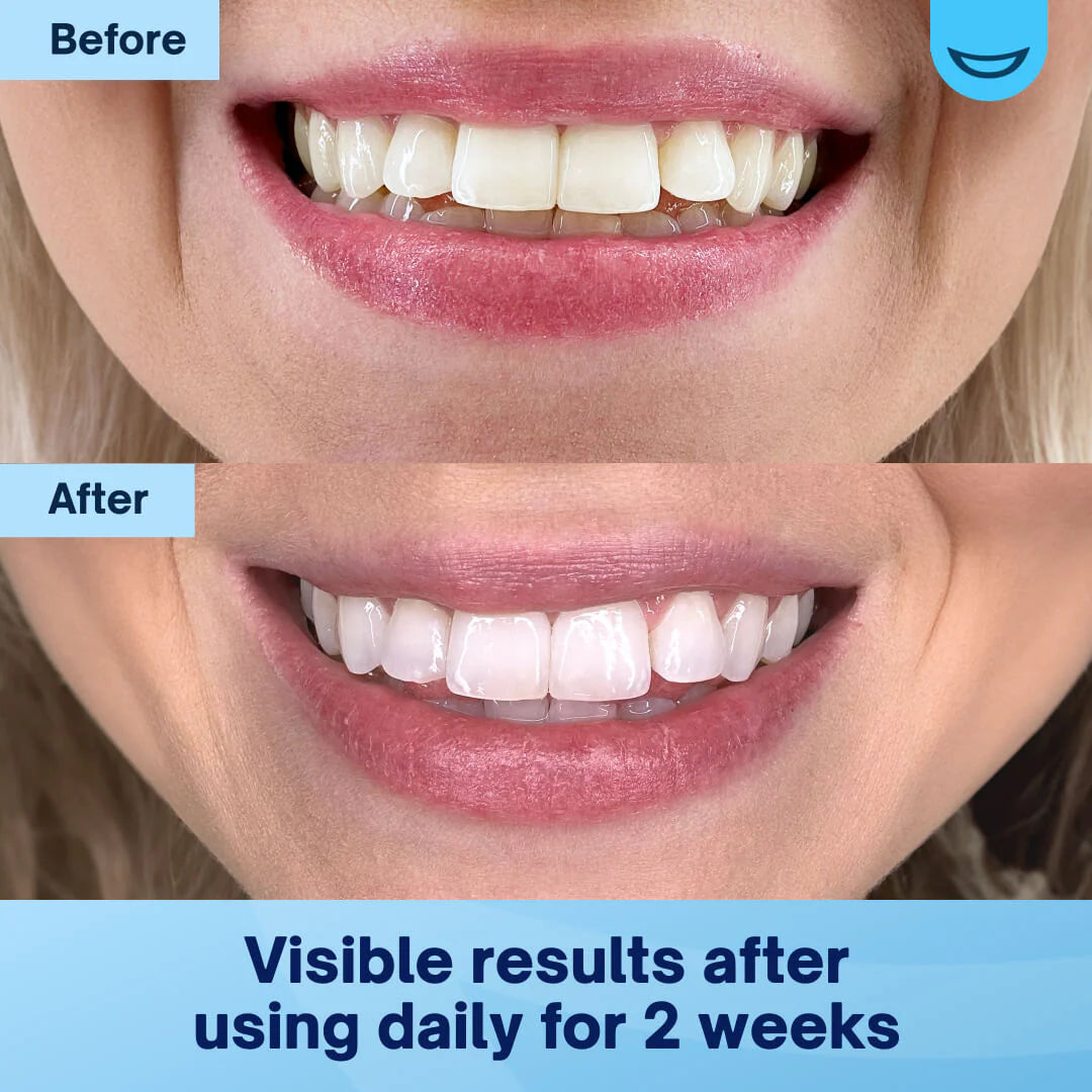 Teeth Whitening Powder – For a Brighter, Confident Smile